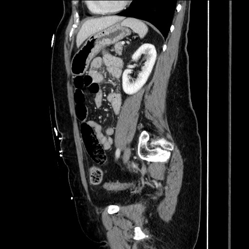 Closed loop small bowel obstruction due to adhesive bands - early and late images (Radiopaedia 83830-99014 C 119).jpg