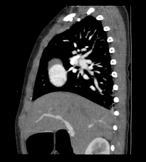 Coarctation of aorta (Radiopaedia 27427-27622 Sagittal C+ CTPA 34).png