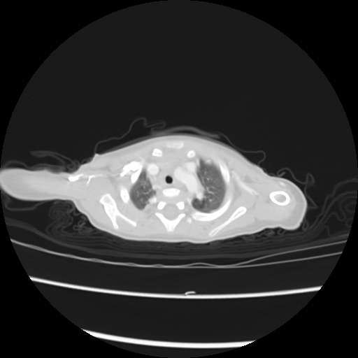 Coarctation of the aorta and patent ductus arteriosus (Radiopaedia 68033-77499 Axial lung window 4).jpg