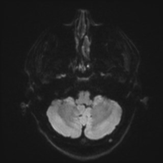 File:Cochlear incomplete partition type III associated with hypothalamic hamartoma (Radiopaedia 88756-105498 Axial DWI 48).jpg