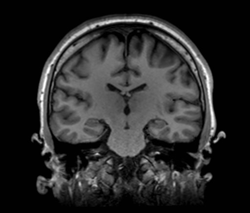 File:Cochlear incomplete partition type III associated with hypothalamic hamartoma (Radiopaedia 88756-105498 Coronal T1 31).jpg