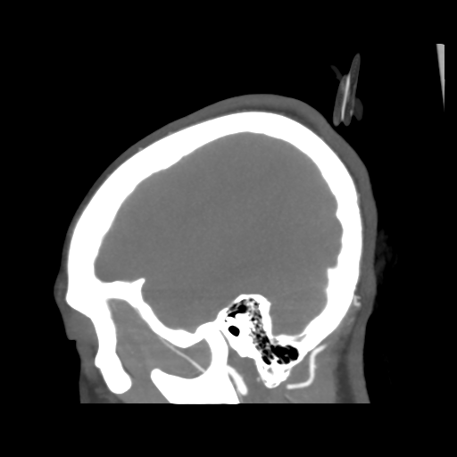 File:Colloid cyst (resulting in death) (Radiopaedia 33423-34499 B 10).png