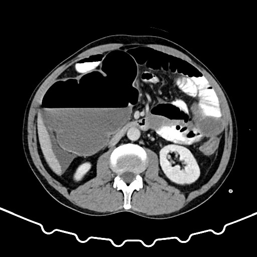 Colocolic intussusception due to large lipoma (Radiopaedia 68773-78482 A 83).jpg