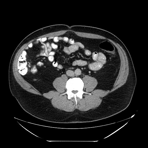 File:Colocolic intussusception due to lipoma (Radiopaedia 73712-84508 Axial 66).jpg