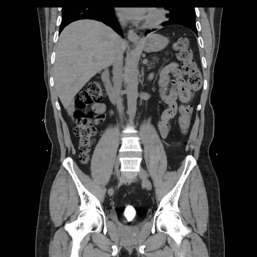 File:Colocutaneous fistula in Crohn's disease (Radiopaedia 29586-30093 E 22).jpg