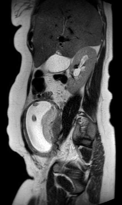 Colon adenocarcinoma with Krukenberg tumors, advanced pregnancy (Radiopaedia 67279-76645 Sagittal T2 35).jpg