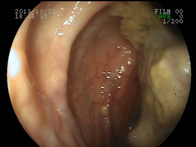 File:Colon carcinoma (Radiopaedia 27713-27927 B 1).jpg