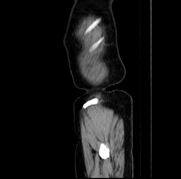 Colon carcinoma with hepatic metastases (Radiopaedia 29477-29961 C 56).jpg