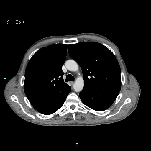 File:Colonic cancer (ultrasound and TC imaging) (Radiopaedia 50346-55713 B 126).jpg
