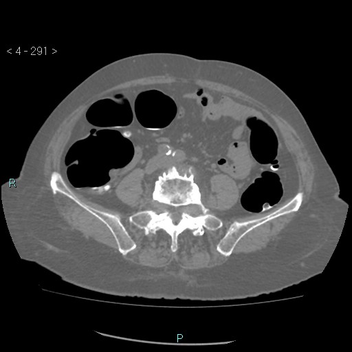 File:Colonic lipomas (Radiopaedia 49137-54244 Axial bone window 129).jpg