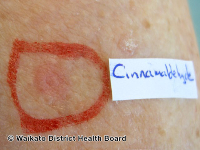 File:Contact urticaria testing (DermNet NZ reactions-w-food-handler-urticaria-06).jpg