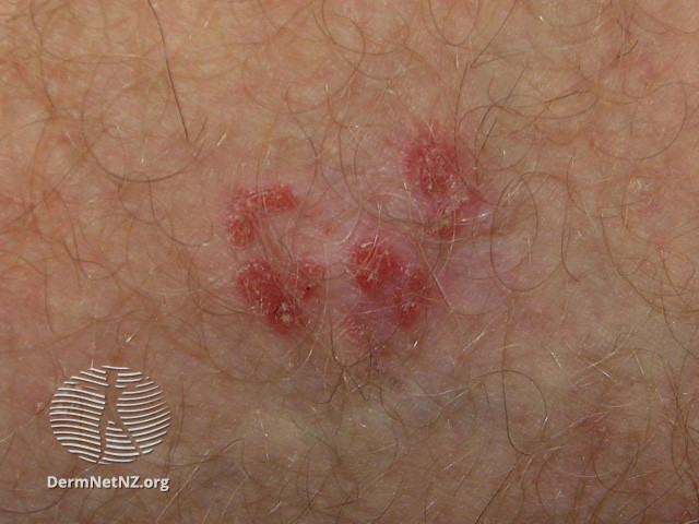 File:Intraepidermal carcinoma (DermNet NZ lesions-scc-in-situ-2955).jpg