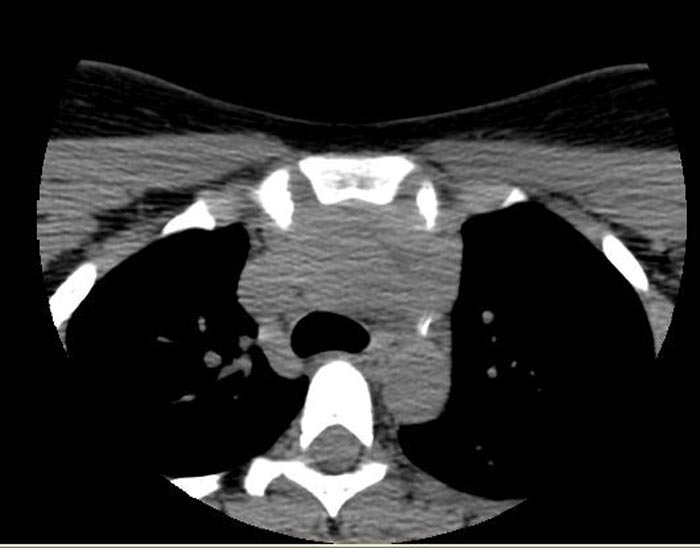 File:Ligamentum arteriosum calficiation (Radiopaedia 11270).jpg