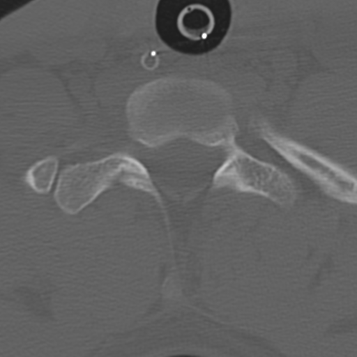 File:Multitrauma with diffuse axonal injury, temporal bone fractures and traumatic caroticocavernous fistula (Radiopaedia 37242-39035 Axial 200).png