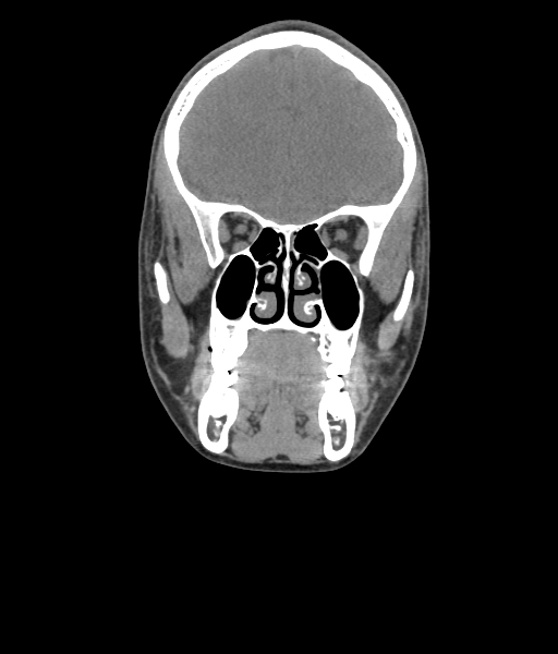 File:Nasal pyogenic granuloma (lobular capillary hemangioma) (Radiopaedia 85536-101244 Coronal non-contrast 94).jpg