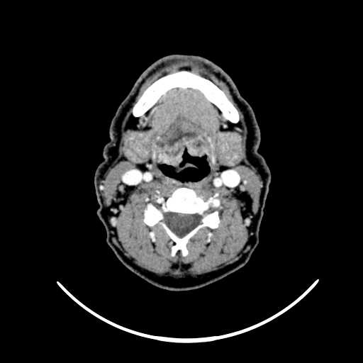 File:Nasopharyngeal carcinoma - infiltrating the clivus (Radiopaedia 62583-70875 Axial Post contrast 42).jpg