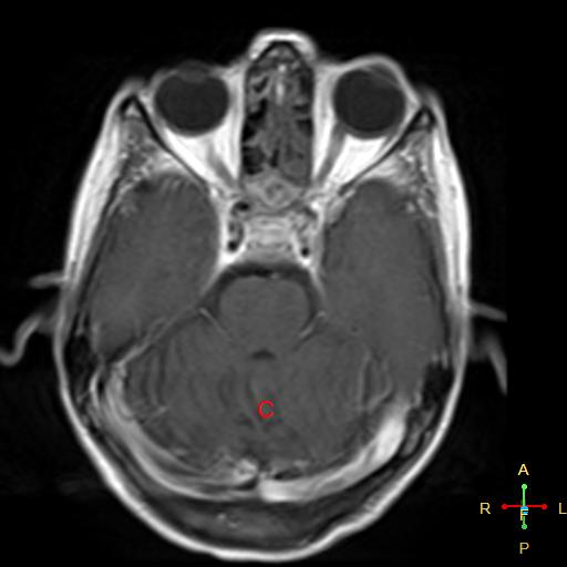 File:Nasopharyngeal carcinoma infiltrating the clivus (Radiopaedia 25229-25481 Axial T1 C+ 10).jpg