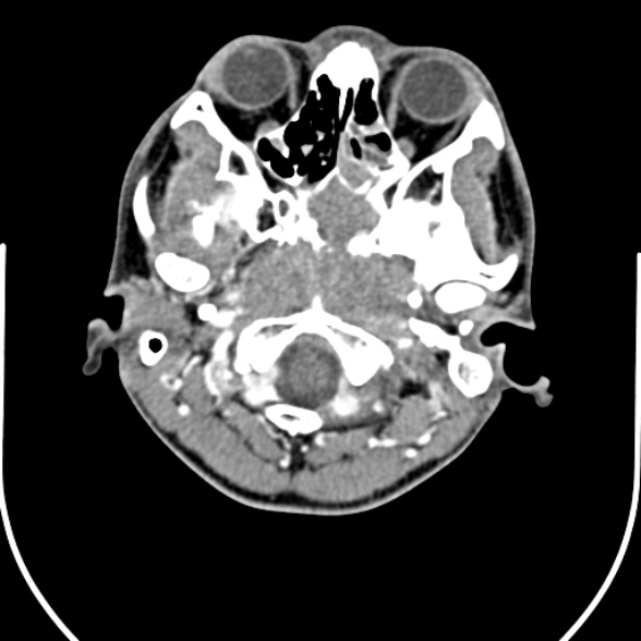 File:Nasopharyngeal carcinoma with skull base invasion (Radiopaedia 53415-59705 A 30).jpg