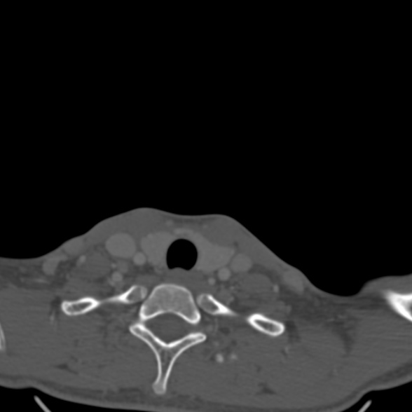 Nasopharyngeal carcinoma with skull base invasion (Radiopaedia 53415-59705 Axial bone window 185).jpg