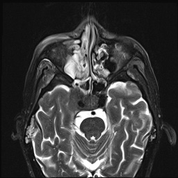 File:Nasopharyngeal carcinoma with skull base invasion (Radiopaedia 59258-66600 D 10).jpg