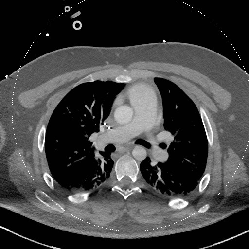 Neck CT angiogram (intraosseous vascular access) (Radiopaedia 55481-61945 B 25).jpg