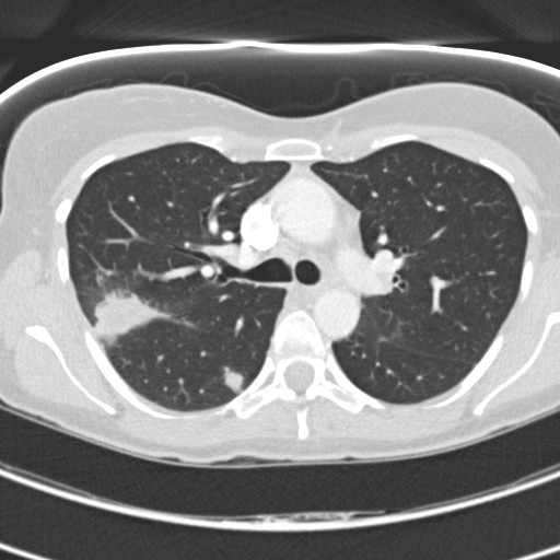 Necrobiotic pulmonary nodules - Crohn disease (Radiopaedia 20723-20631 Axial lung window 52).jpg