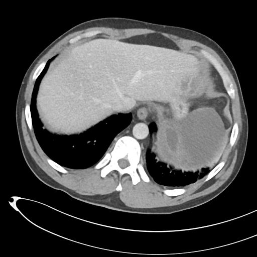 File:Necrotizing pancreatitis with acute necrotic collections (Radiopaedia 38829-41012 B 13).png