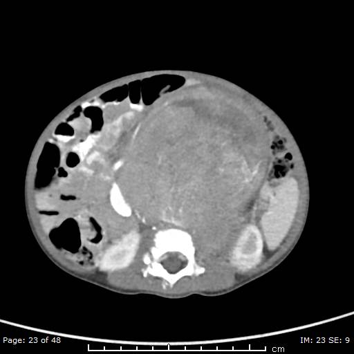 File:Neuroblastoma (Radiopaedia 41472-44355 A 23).jpg