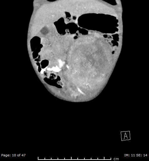 File:Neuroblastoma (Radiopaedia 41472-44355 B 10).jpg