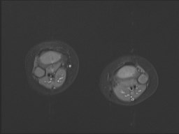 File:Neuroblastoma with bone metastases (Radiopaedia 67080-76414 Axial STIR 1).jpg