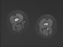 File:Neuroblastoma with bone metastases (Radiopaedia 67080-76414 Axial STIR 18).jpg