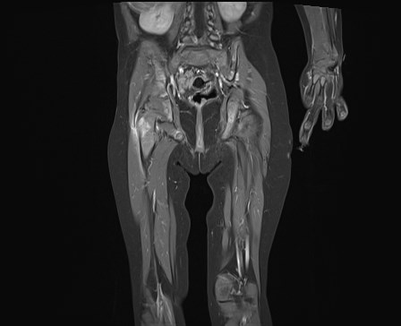 File:Neuroblastoma with bone metastases (Radiopaedia 67080-76414 E 16).jpg