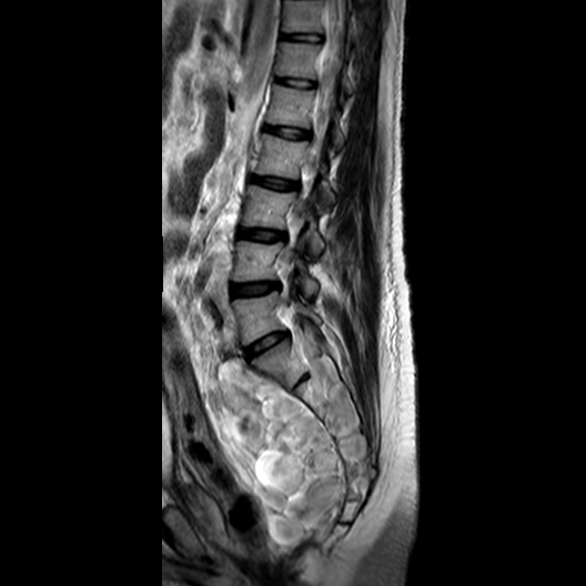 File:Neurofibromatosis type 1- extensive spinal involvement and Christmas tree sign (Radiopaedia 60610-68332 Sagittal T2 7).jpg