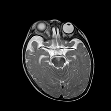File:Neurofibromatosis type 1 (Radiopaedia 30089-30671 Axial T2 9).jpg