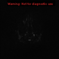 File:Neurofibromatosis type 1 with optic nerve glioma (Radiopaedia 16288-15965 Axial DWI 70).jpg