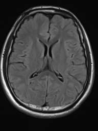 File:Neurofibromatosis type 2 (Radiopaedia 44936-48838 Axial FLAIR 14).png