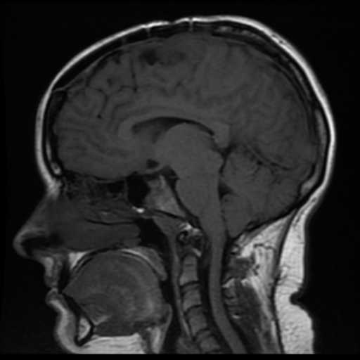 File:Neurofibromatosis type 2 (Radiopaedia 45229-49247 Sagittal T1 11).png