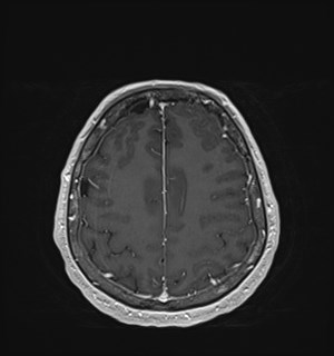 Neurofibromatosis type 2 (Radiopaedia 79097-92049 Axial T1 C+ 153).jpg