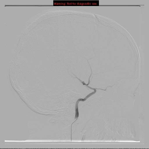 File:Neurofibromatosis type 2 (Radiopaedia 8953-9733 C 2).jpg