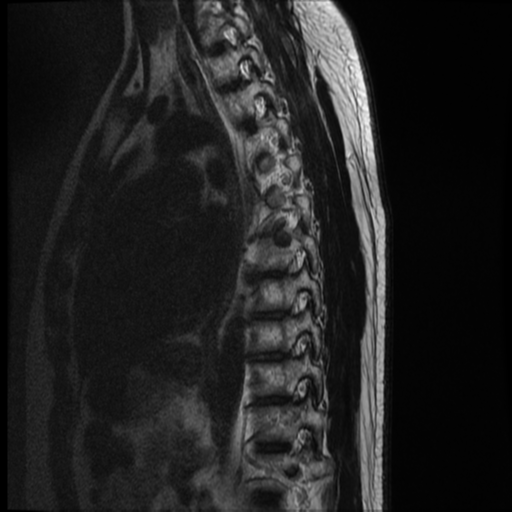 File:Neurofibromatosis type 2 (spinal manifestations) (Radiopaedia 53943-60070 C 4).png