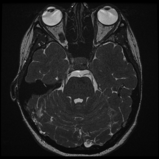 File:Neurofibromatosis type 2 - bilateral acoustic neuromata (Radiopaedia 40060-42566 Axial FIESTA 60).png
