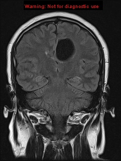 File:Neuroglial cyst (Radiopaedia 10713-11184 Coronal FLAIR 12).jpg
