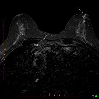 File:Nipple adenoma (Radiopaedia 32880-33857 Axial T2 fat sat 1).jpg