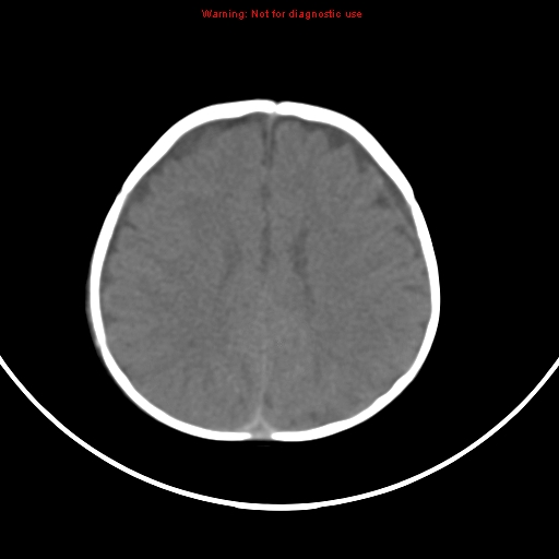 File:Non-accidental injury - bilateral subdural with acute blood (Radiopaedia 10236-10765 Axial non-contrast 15).jpg