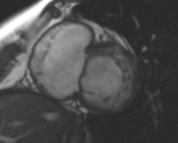 File:Non-compaction of the left ventricle (Radiopaedia 69436-79314 Short axis cine 180).jpg