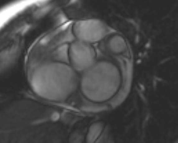 File:Non-compaction of the left ventricle (Radiopaedia 69436-79314 Short axis cine 205).jpg