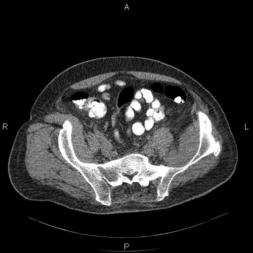 File:Non Hodgkin lymphoma in a patient with ankylosing spondylitis (Radiopaedia 84323-99624 Axial non-contrast 54).jpg
