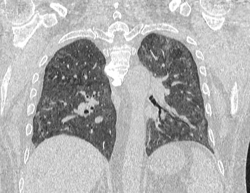 Non specific interstitial pneumonia (NSIP) (Radiopaedia 89725-106798 Coronal lung window 49).jpg