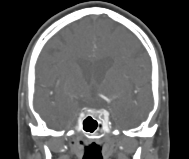 File:Normal CTA head (Radiopaedia 40801-43464 B 46).png