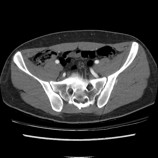 File:Normal CT angiogram of pelvis (Radiopaedia 45390-49430 A 30).jpg